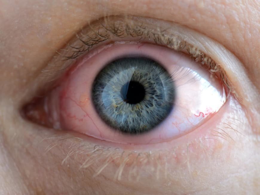 Trockene Augen sind schmerzhaft und sollten behandelt werden
