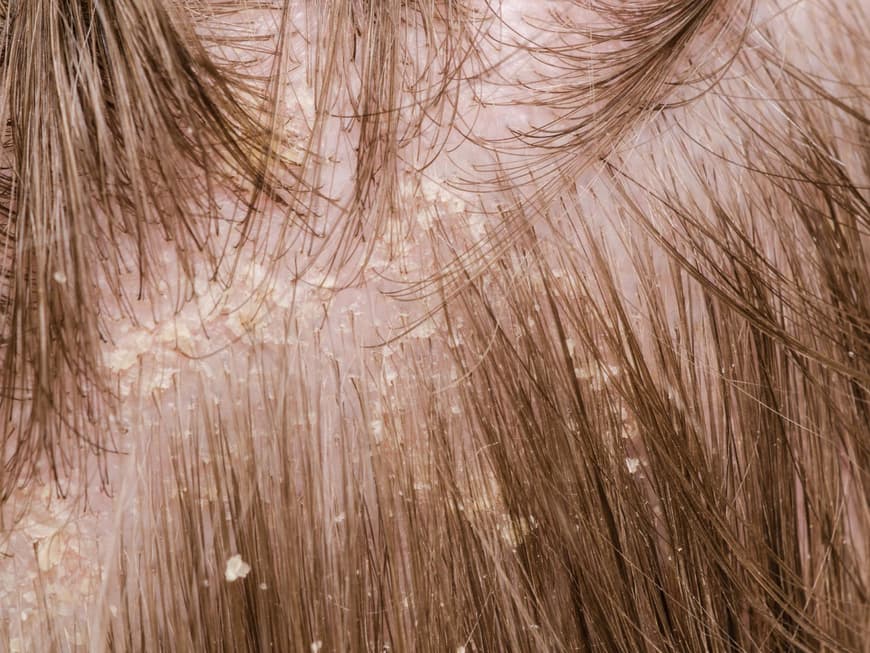 Gegen Schuppen im Haar können Sie erfolgreich vorgehen