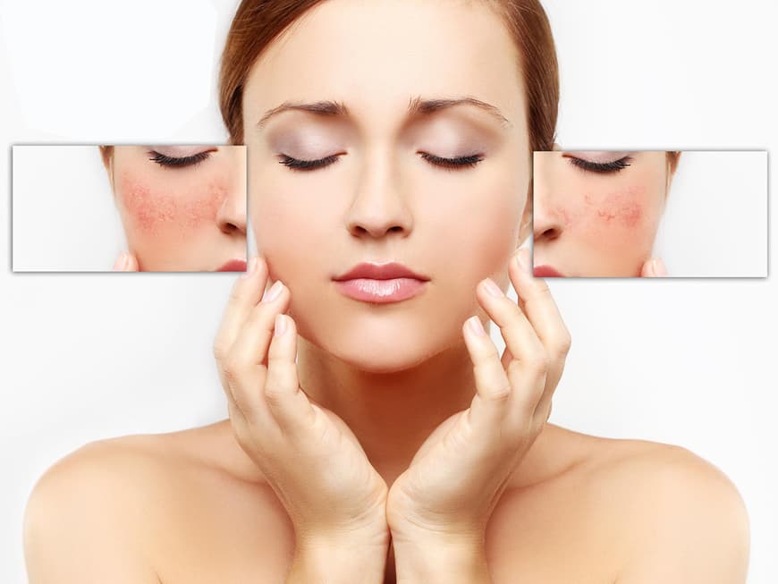 Rosacea: Was sind die Ursachen, Symptome und Behandlungsmöglichkeiten?