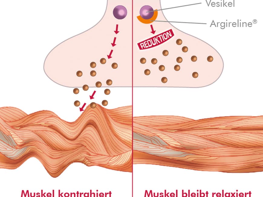 So wirkt der Kosmetik-Wunderstoff: Argireline® ist auch unter dem chemischen Namen „Acetyl Hexapeptid“ bekannt. Es hemmt die Ausschüttung der Neurotransmitter, welche die Kontraktion der oberflächigen Gesichtsmuskeln z. B. beim Stirnrunzeln oder Lachen steuern. Durch seine entspannende Wirkung auf die aktive Mimik-Muskulatur entwickelt es ähnlich faltenglättende Eigenschaften wie Botox. Studien und Lasermessungen haben gezeigt, dass Argireline die Faltentiefe nachhaltig um bis zu 50 Prozent reduzieren kann.