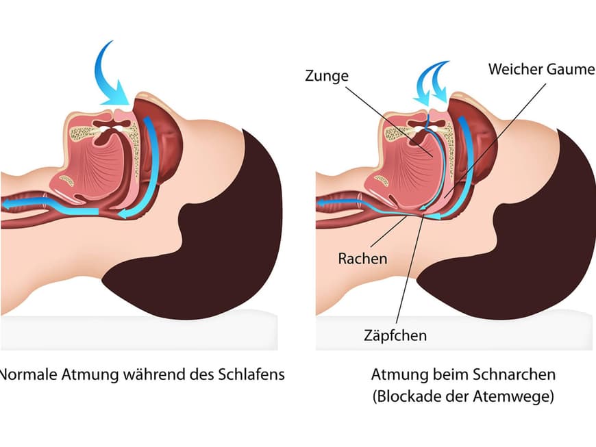 Anatomische Grafik von einem normal atmenden Menschen neben einem schnarchenden Menschen