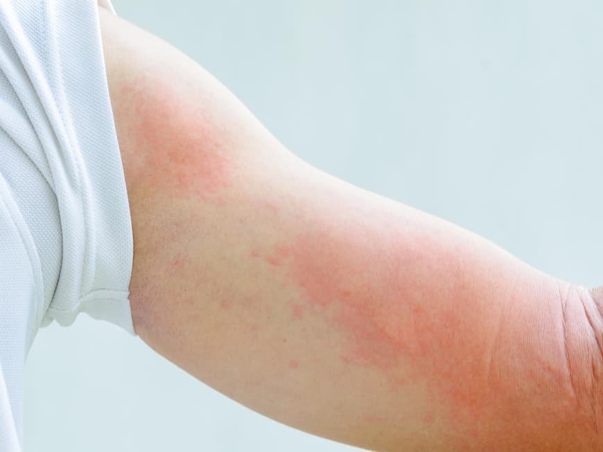 Allergische Hautreaktion auf Arm
