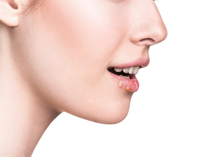Auch Hausmittel können gegen Herpes helfen.