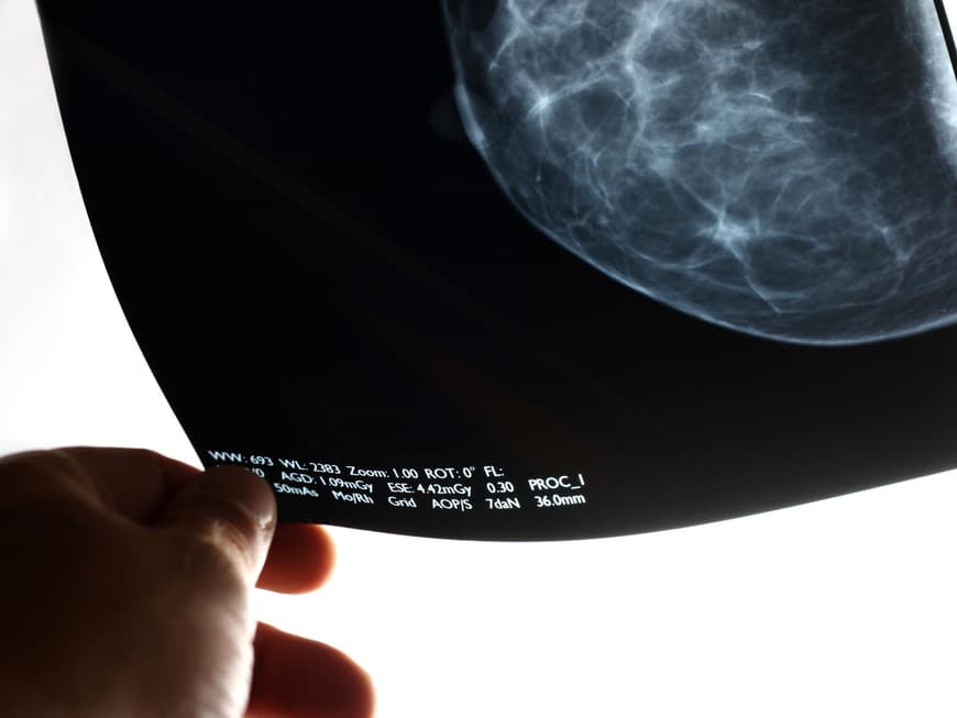 Arzt hält Bild einer Mammografie