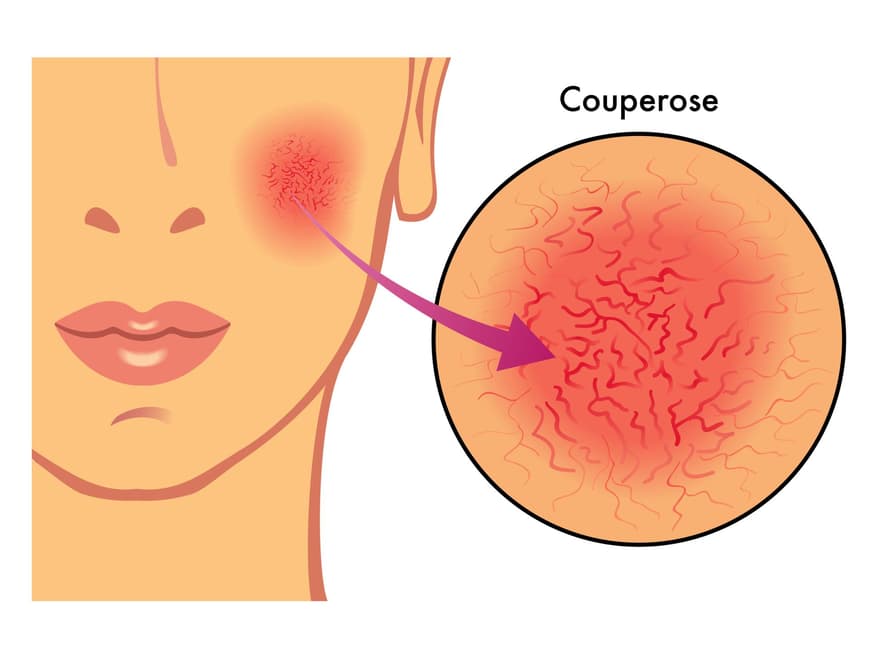 Frau mit Rosacea auf der Wange