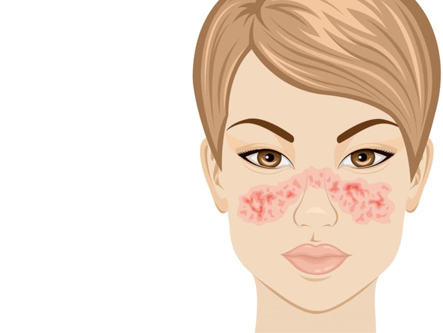 Ein typisches Symptom bei Lupus ist der schmetterlingsförmige Ausschlag im Gesicht