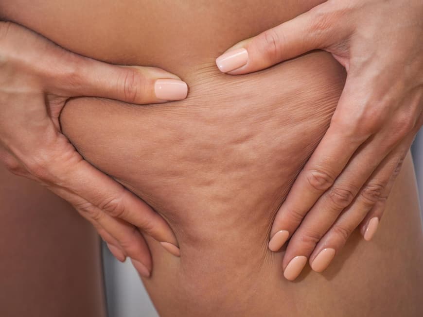 Cellulite