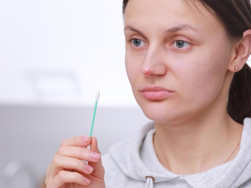 Frau mit Nasenherpes