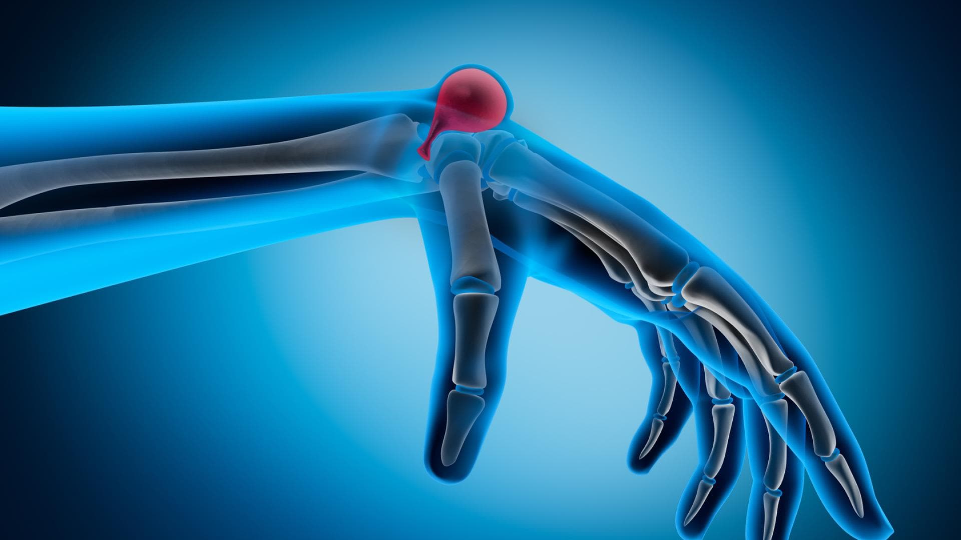 Überbein behandeln Was muss ich tun?